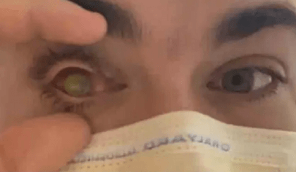 Man sleeps with contact lenses on, flesh-eating parasites eat his eye