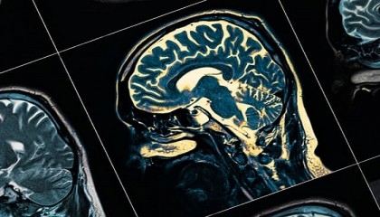 Potential 'game-changer' in diagnosing Parkinson's disease