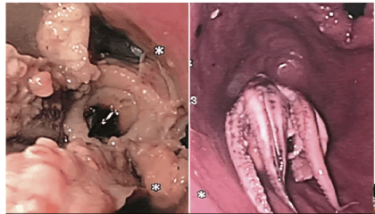 Man visits hospital complaining of vomiting, they find octopus stuck in his throat