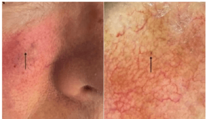 Almost invisible spot under woman's eye turns out to be world's smallest skin cancer