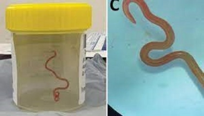 Australian doctors find live parasitic worm in woman's brain